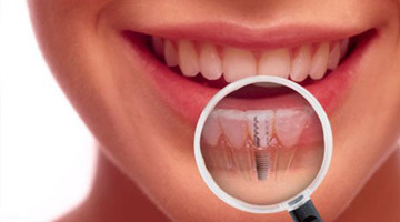 Dental Implants Clinic Jalandhar