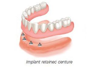 Dental Implants Centre Punjab