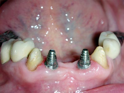 Single Piece Implants