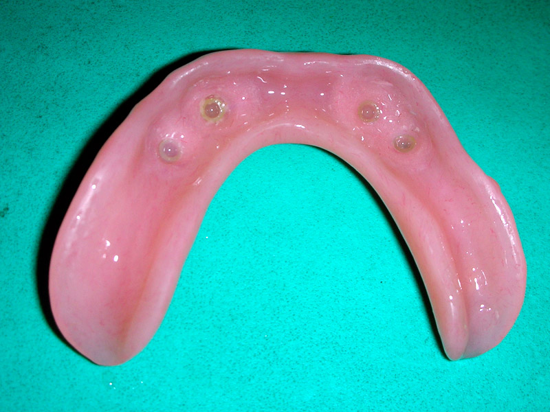 Dentures Treatment Clinic Punjab, Goyal Dental Clinic