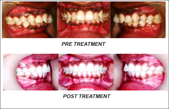 Dental Implants Jalandhar, Punjab