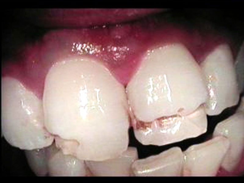 Crowns For Protruding and <br>
Malformed Teeth