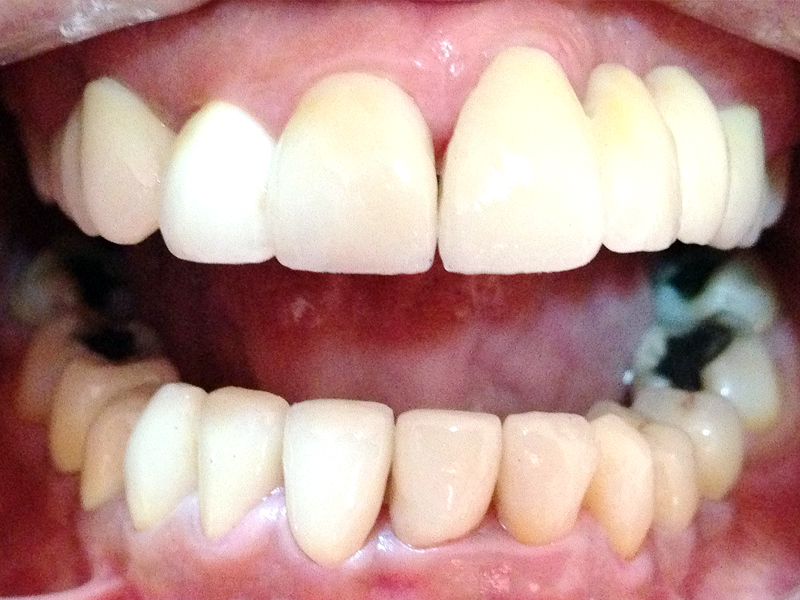 Tooth Whitening Jalandhar