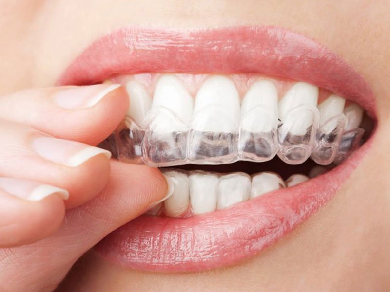 Tooth Whitening Treatment Jalandhar, Tooth Whitening System