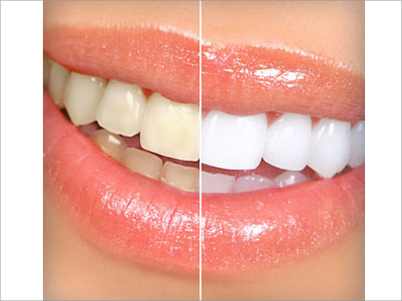 Tooth Whitening Treatment Clinic Jalandhar, Goyal Dental Clinic Centre Punjab