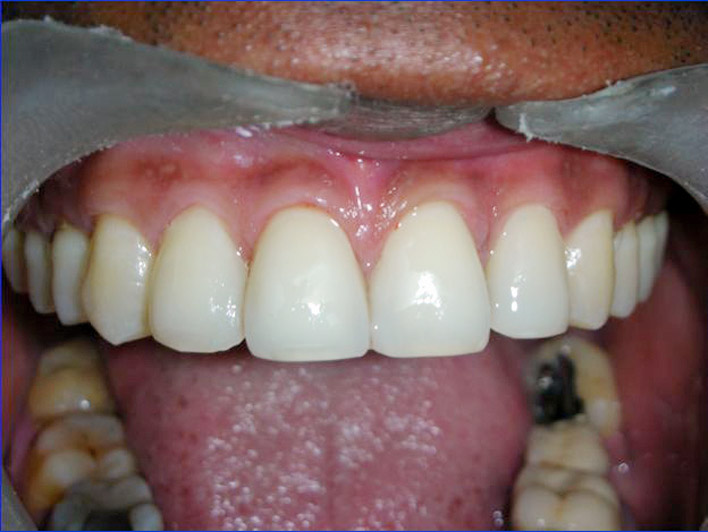 Dental  Veneer  Treatment